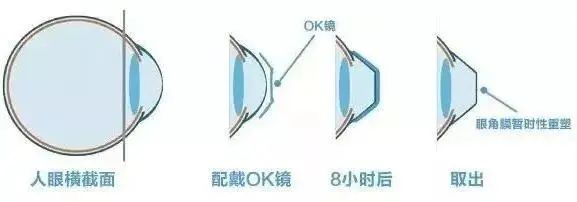 进口医疗器械角膜塑形镜若何报关？